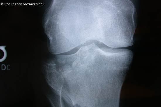 lee_knee_xray