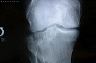lee_knee_xray